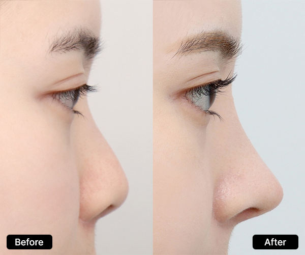 THEGETSMARTBLOG.COM – Operasi Hidung Modern: Teknologi yang Mengubah Standar Estetika